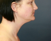 Feel Beautiful - Liposuction Neck San Diego Case 10 - Before Photo